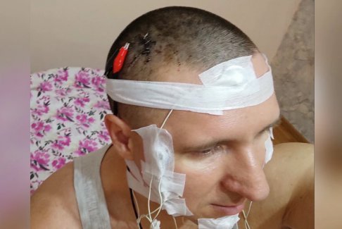 俄羅斯男子在家給自己做腦部植入芯片手術(shù)差點(diǎn)喪命