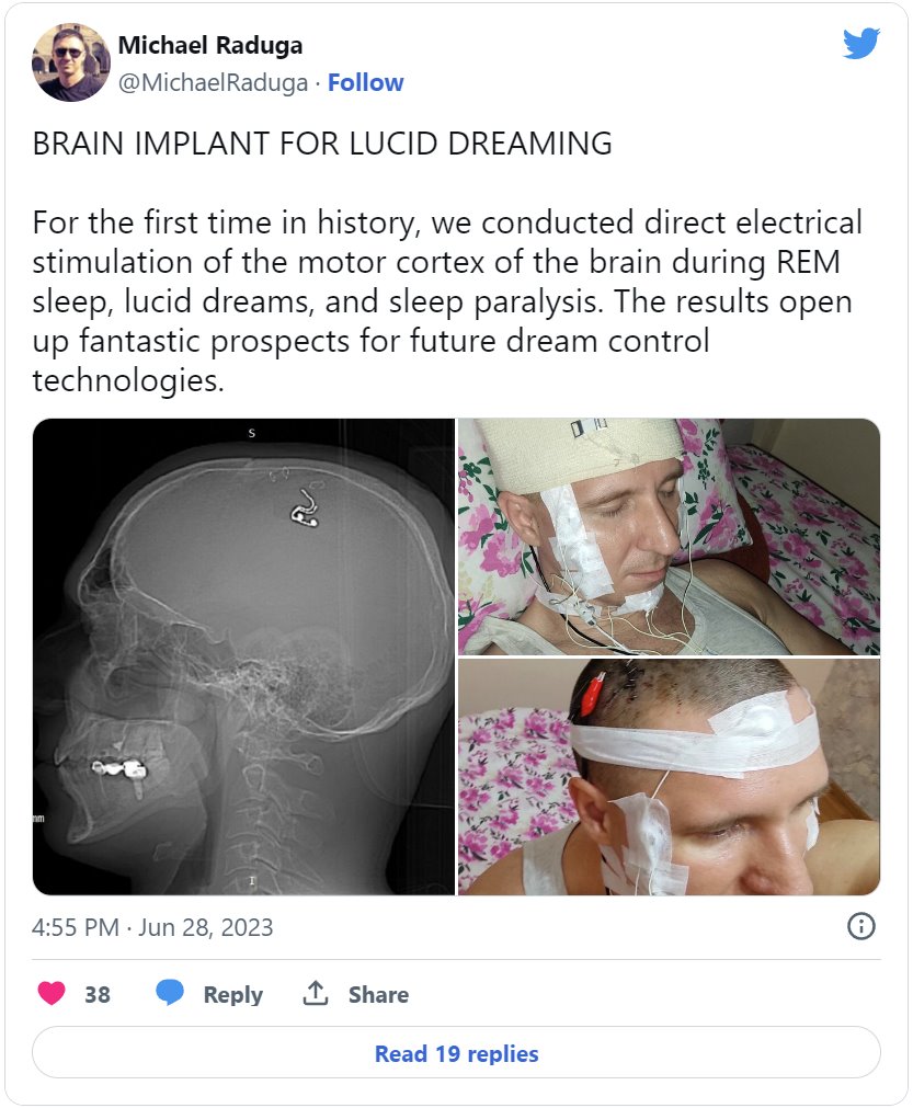 俄羅斯男子在家給自己做腦補植入芯片手術(shù)差點喪命