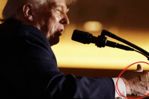 白宮談特朗普手上貼著創(chuàng)口貼