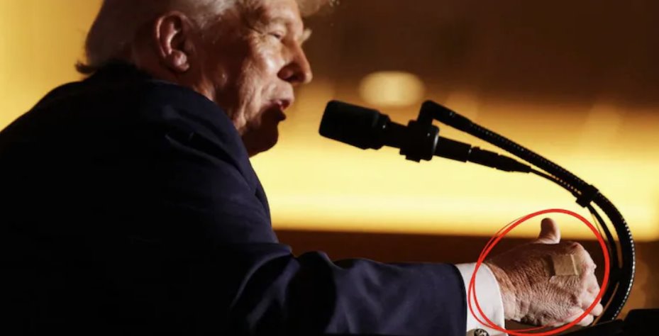 美國總統(tǒng)唐納德&middot;特朗普在一次活動中發(fā)表講話時，右手上貼著創(chuàng)口貼。